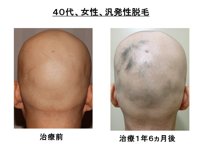 円形脱毛症　病院